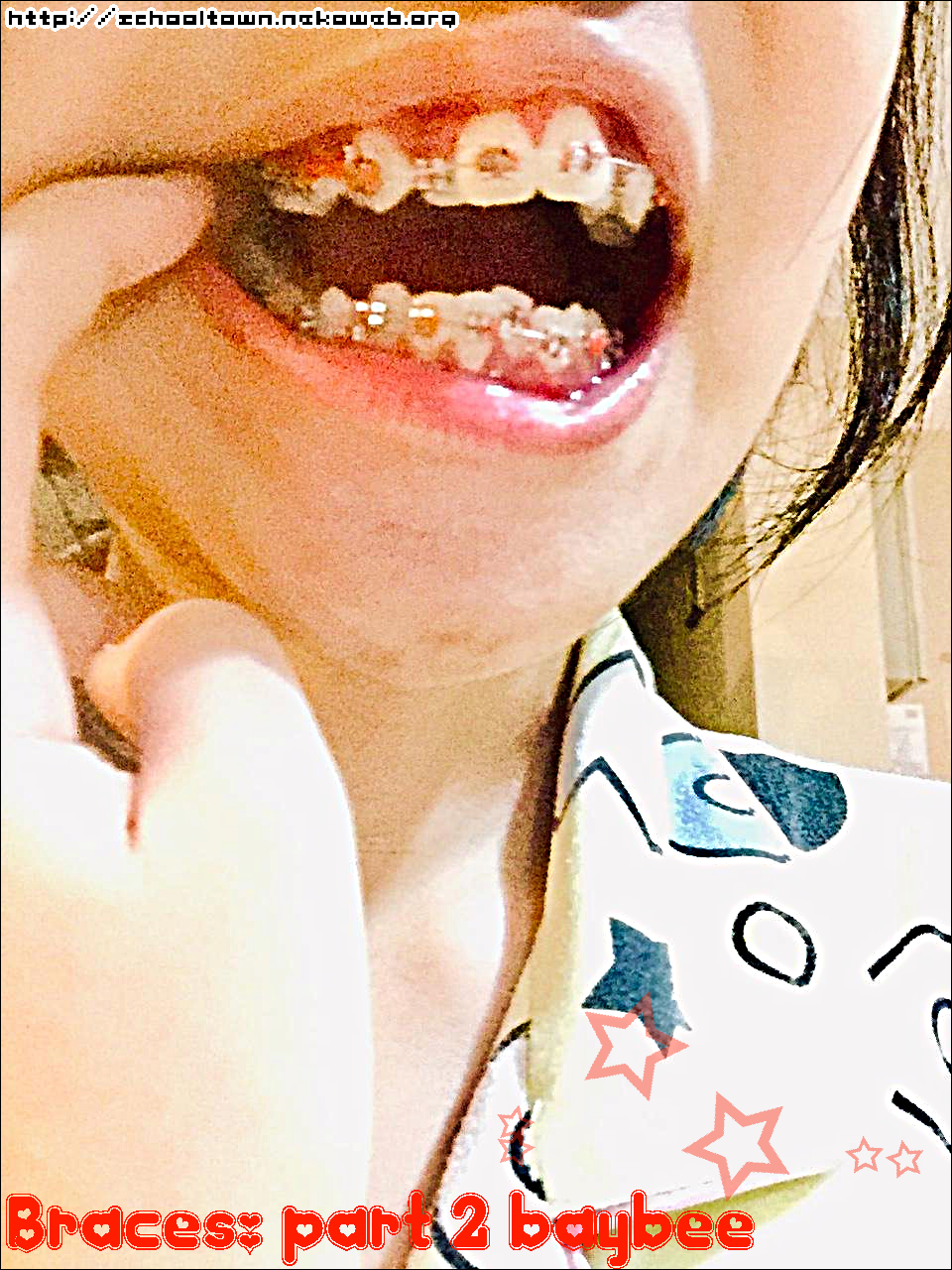 braces with reddish-orange elastics on each bracket